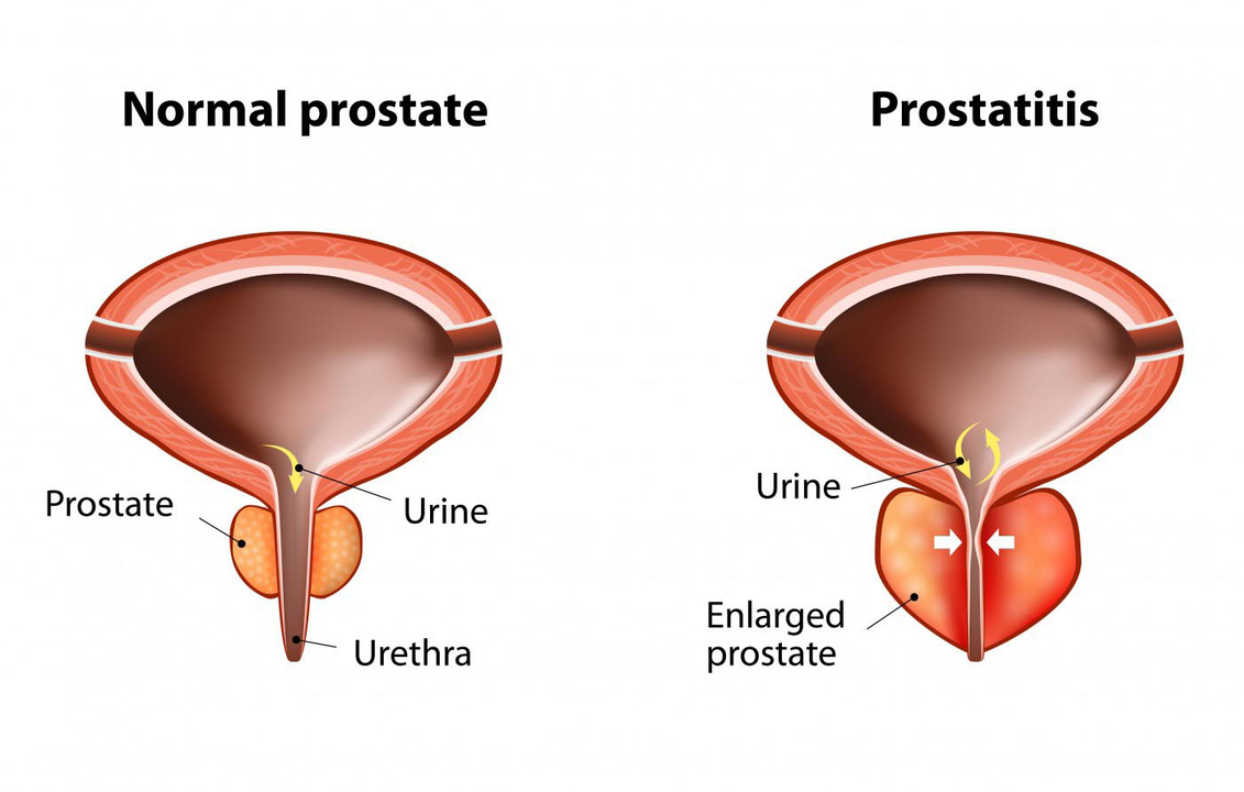 Prostate normale d'un homme en bonne santé et inflammation de la prostate avec prostatite
